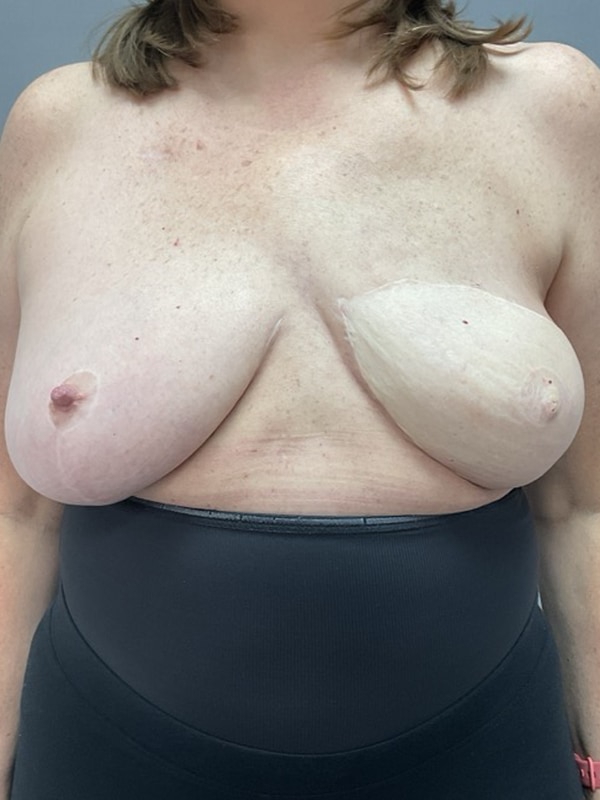 Breast Reconstruction Before & After Image