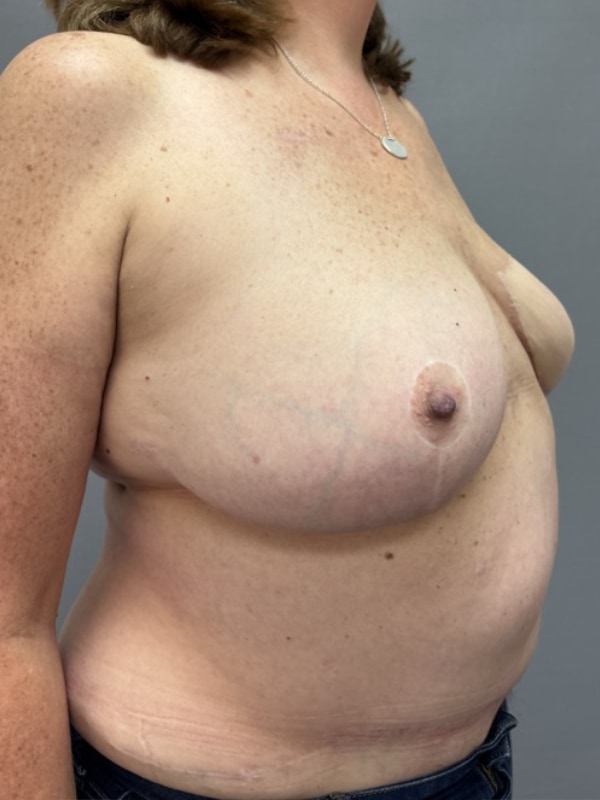 Breast Reconstruction Before & After Image