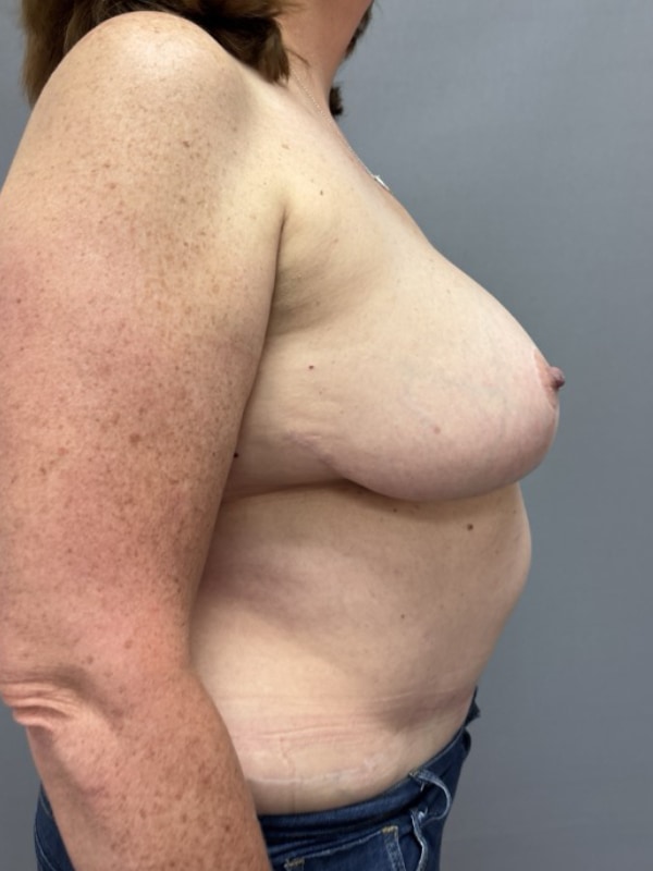 Breast Reconstruction Before & After Image