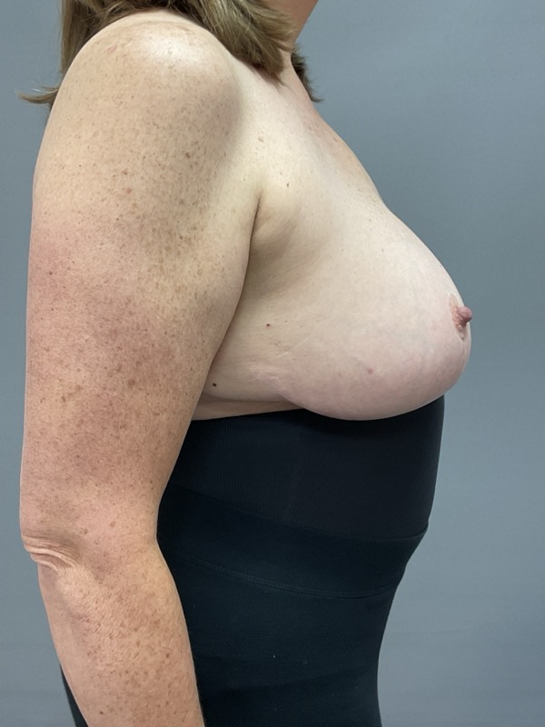 Breast Reconstruction Before & After Image