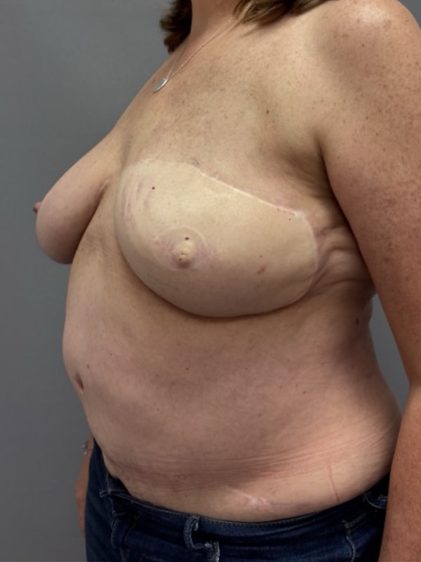 Breast Reconstruction Before & After Image