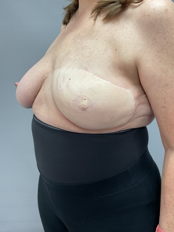 Breast Reconstruction Before & After Image