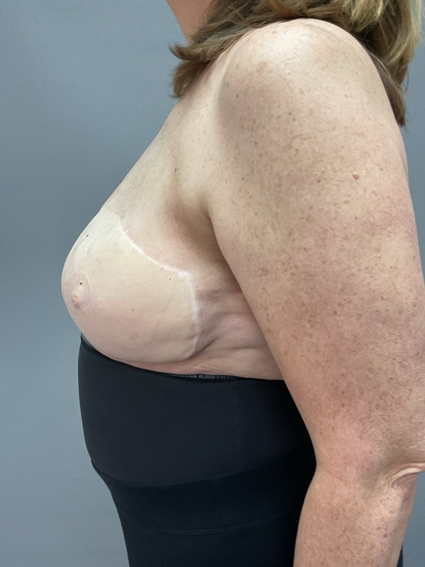 Breast Reconstruction Before & After Image