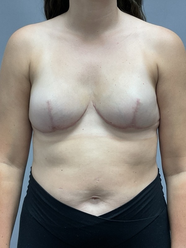 Breast Reconstruction Before & After Image