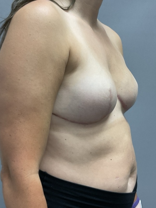 Breast Reconstruction Before & After Image