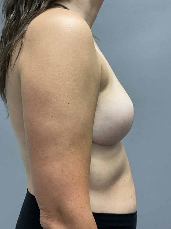 Breast Reconstruction Before & After Image