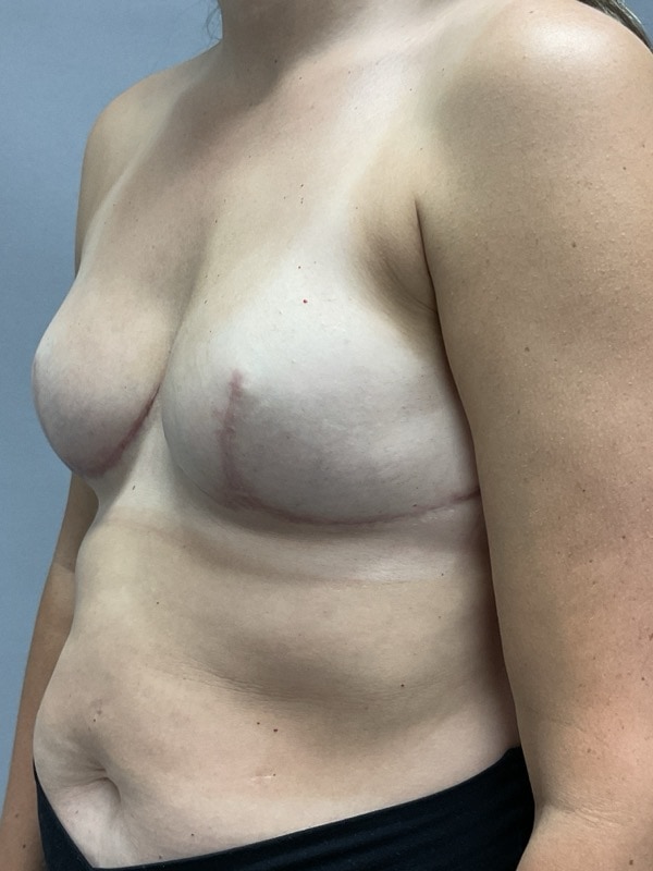 Breast Reconstruction Before & After Image