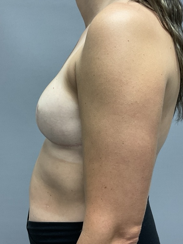 Breast Reconstruction Before & After Image