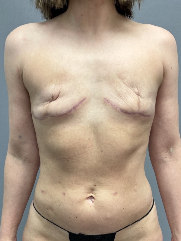 Breast Reconstruction Before & After Image