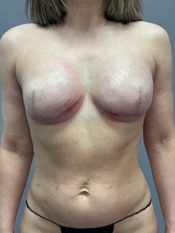 Breast Reconstruction Before & After Image