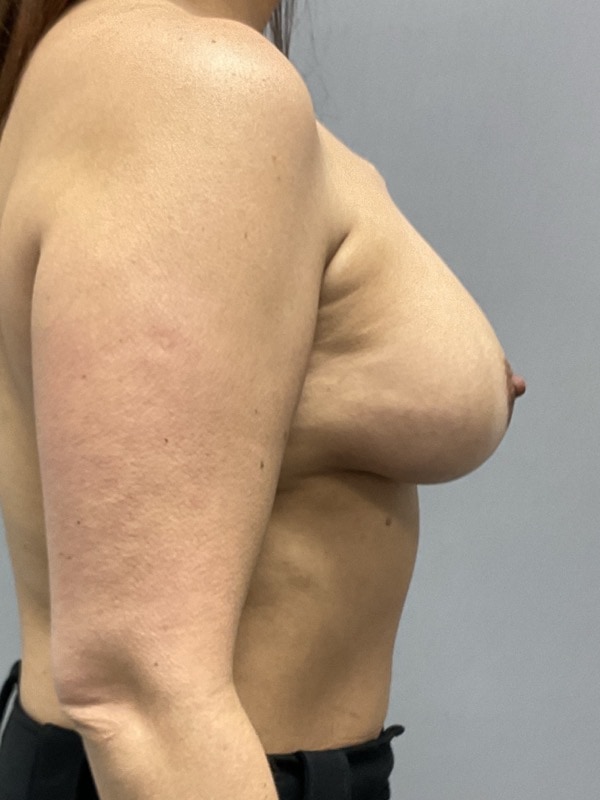 Breast Reconstruction Before & After Image