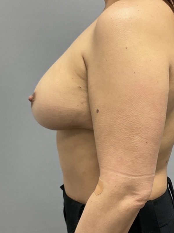 Breast Reconstruction Before & After Image