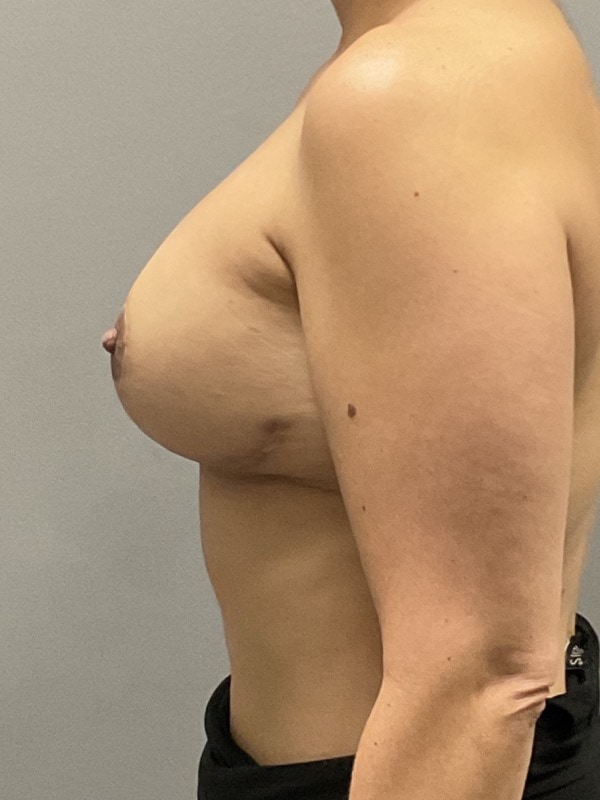 Breast Reconstruction Before & After Image
