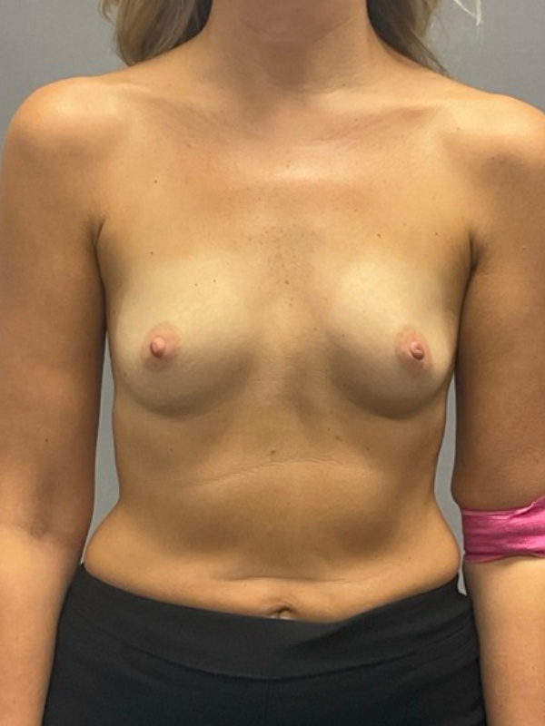 Breast Reconstruction Before & After Image