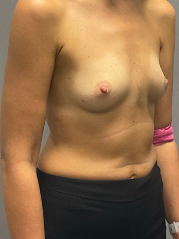 Breast Reconstruction Before & After Image