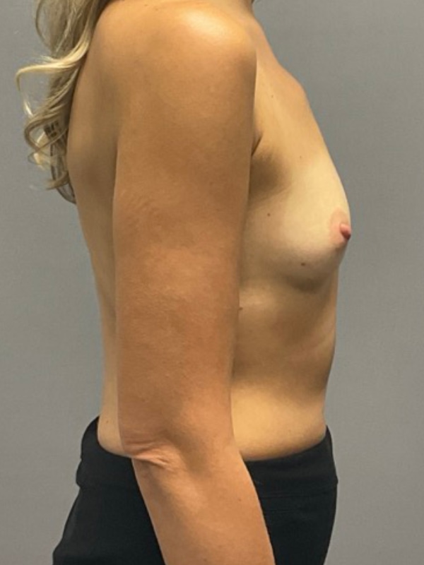 Breast Reconstruction Before & After Image