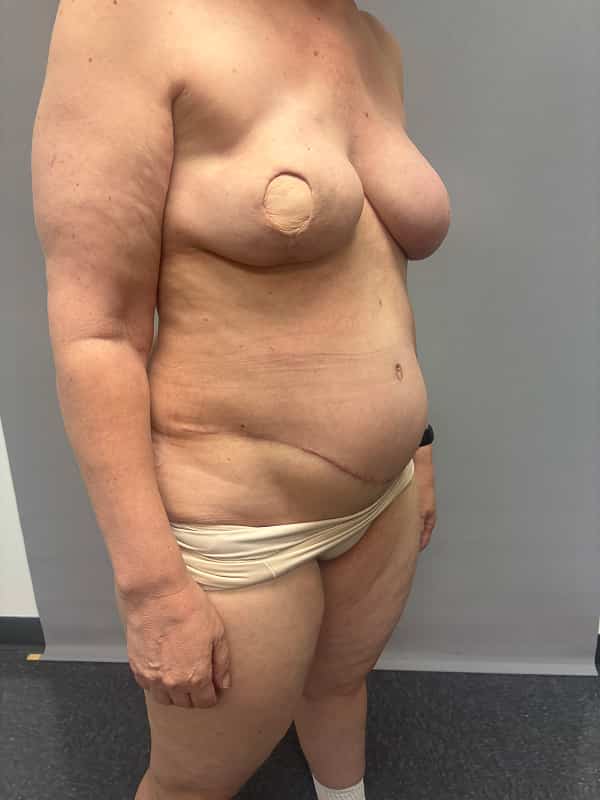 Breast Reconstruction Before & After Image