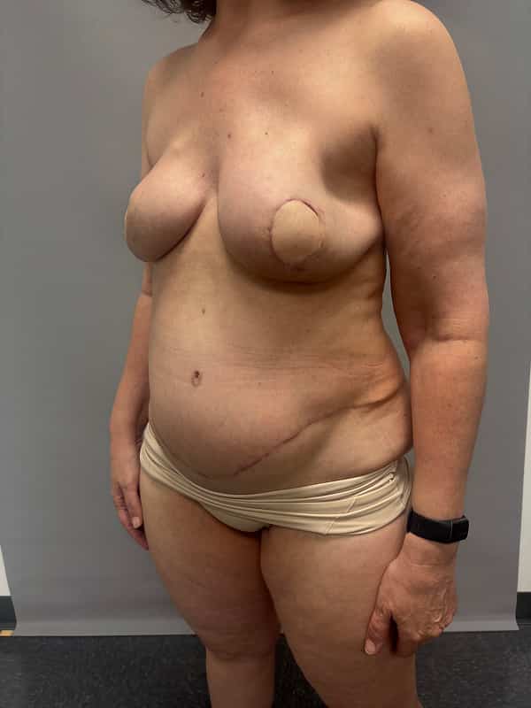Breast Reconstruction Before & After Image