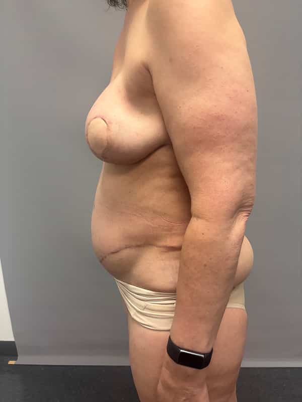 Breast Reconstruction Before & After Image