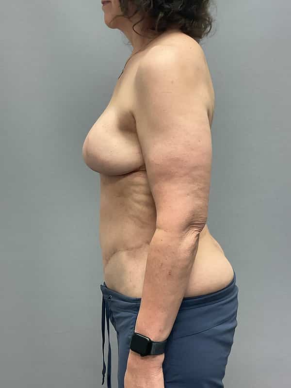 Breast Reconstruction Before & After Image