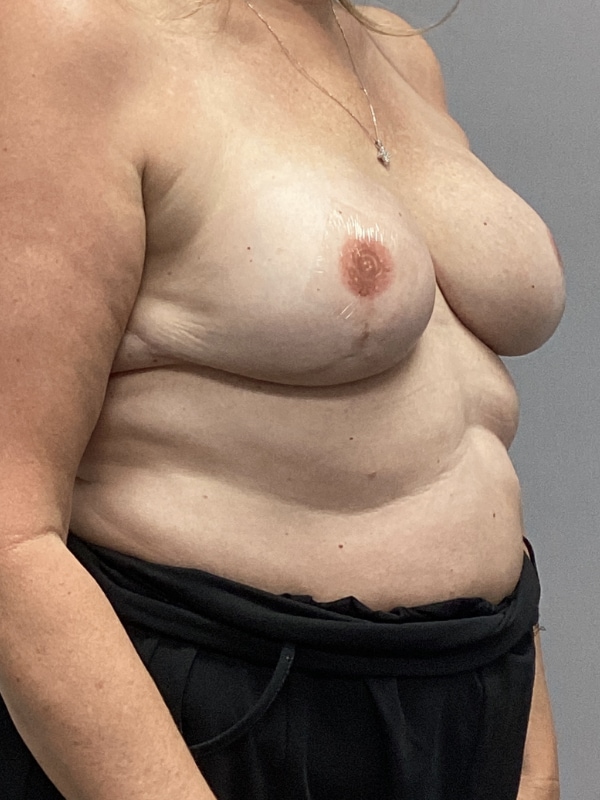 Breast Reconstruction Before & After Image