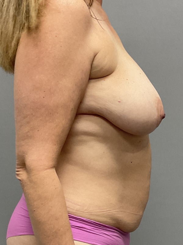 Breast Reconstruction Before & After Image