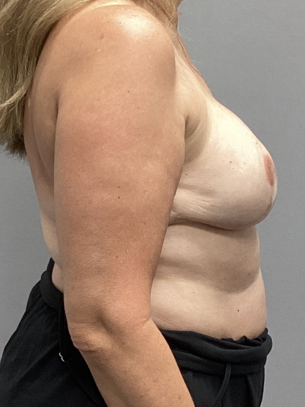 Breast Reconstruction Before & After Image