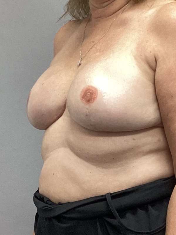 Breast Reconstruction Before & After Image