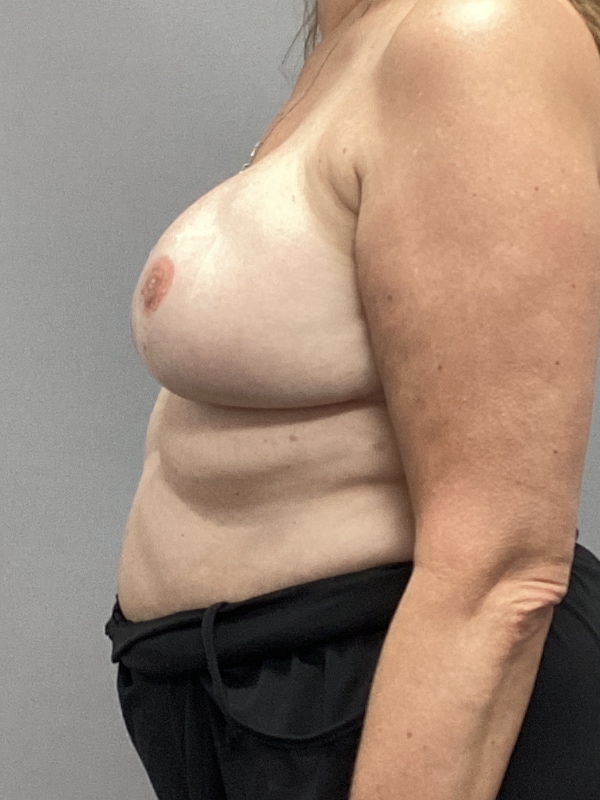 Breast Reconstruction Before & After Image