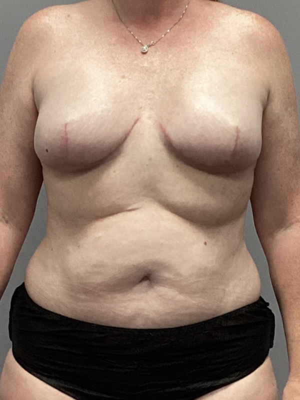 Breast Reconstruction Before & After Image