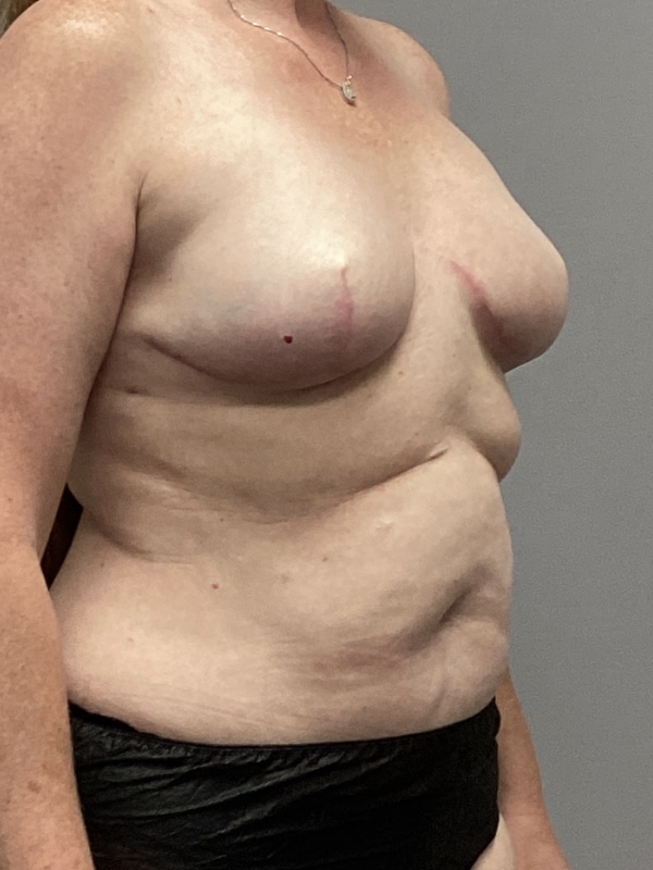 Breast Reconstruction Before & After Image