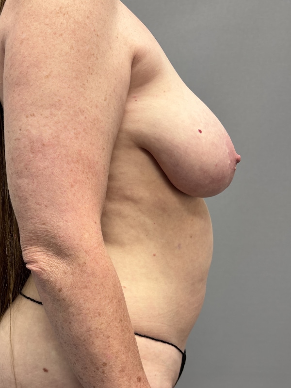 Breast Reconstruction Before & After Image