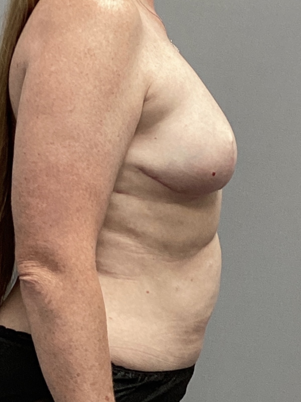 Breast Reconstruction Before & After Image