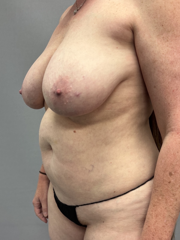 Breast Reconstruction Before & After Image