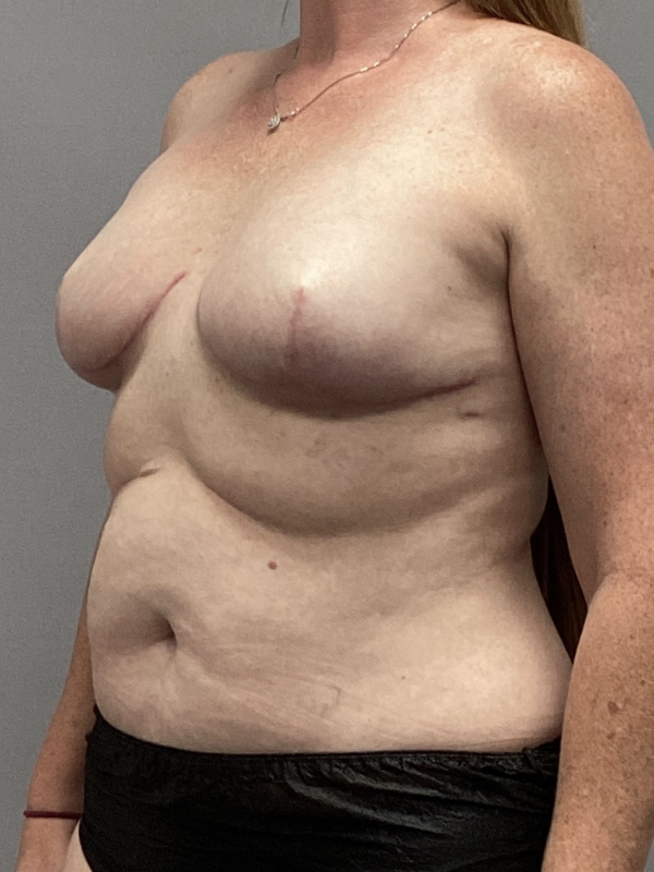 Breast Reconstruction Before & After Image