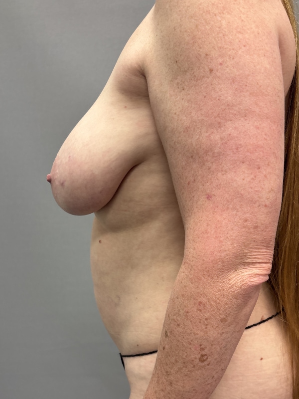 Breast Reconstruction Before & After Image