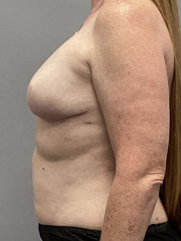 Breast Reconstruction Before & After Image