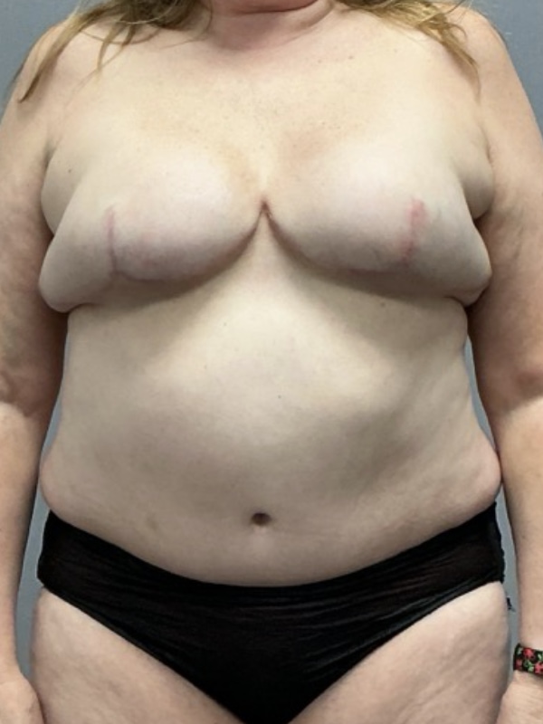 Breast Reconstruction Before & After Image