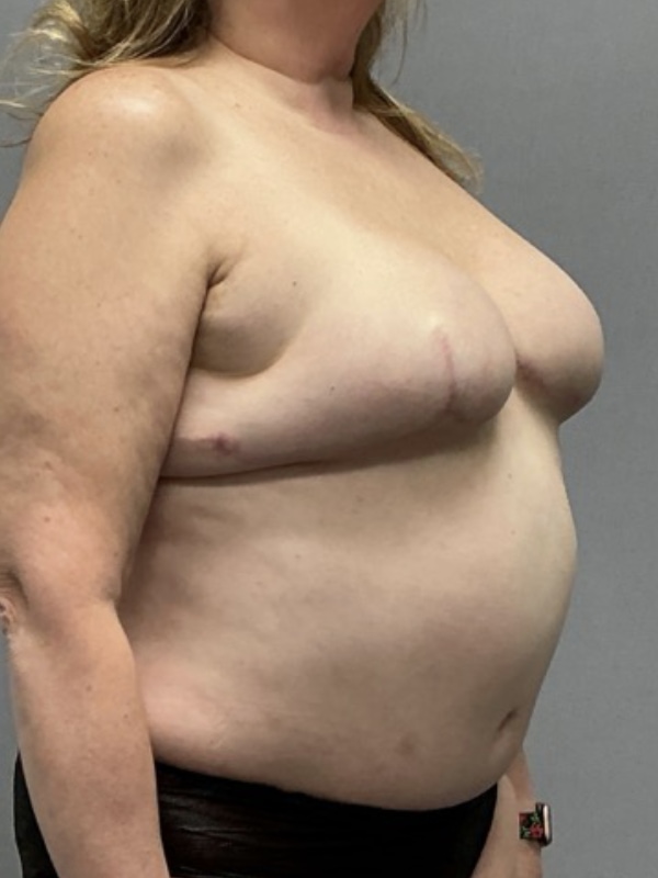 Breast Reconstruction Before & After Image