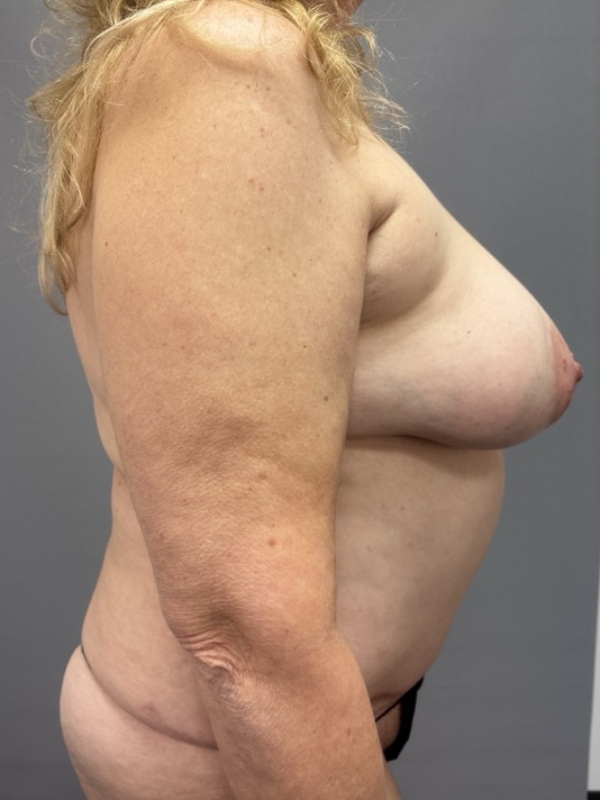Breast Reconstruction Before & After Image