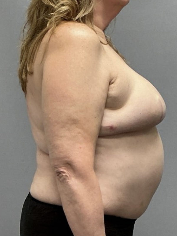 Breast Reconstruction Before & After Image