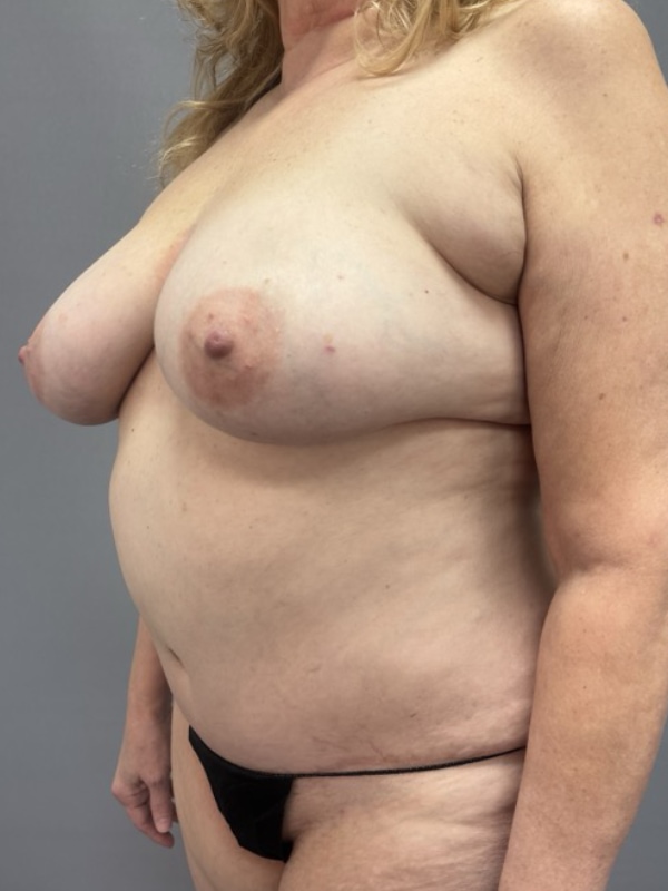 Breast Reconstruction Before & After Image