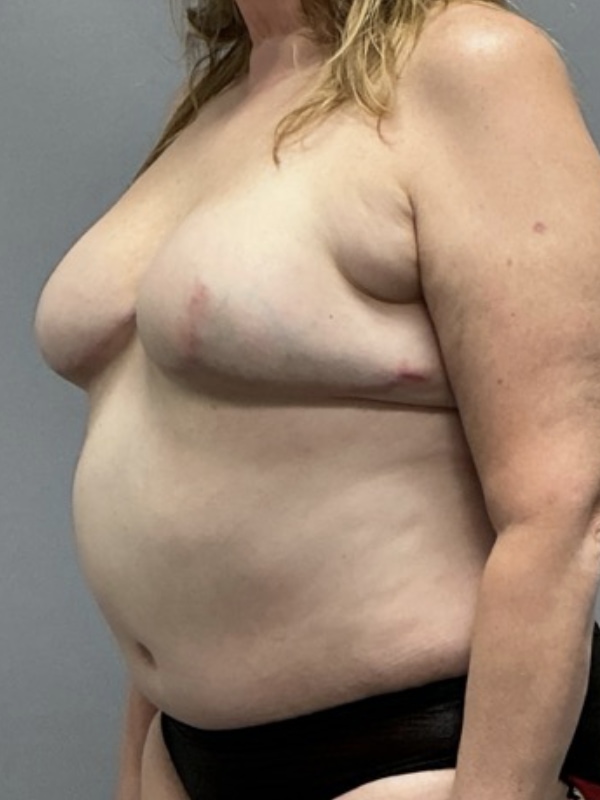 Breast Reconstruction Before & After Image