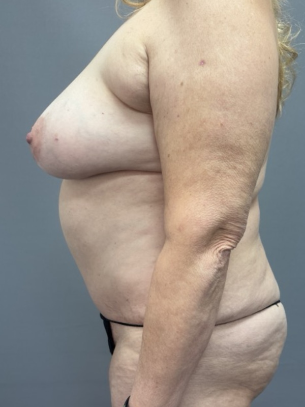 Breast Reconstruction Before & After Image