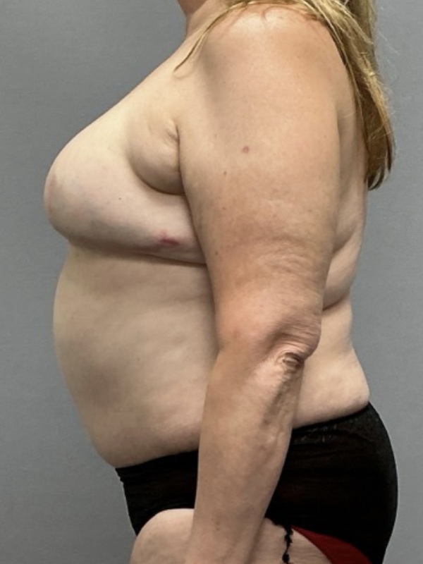Breast Reconstruction Before & After Image