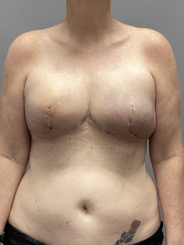 Breast Reconstruction Before & After Image