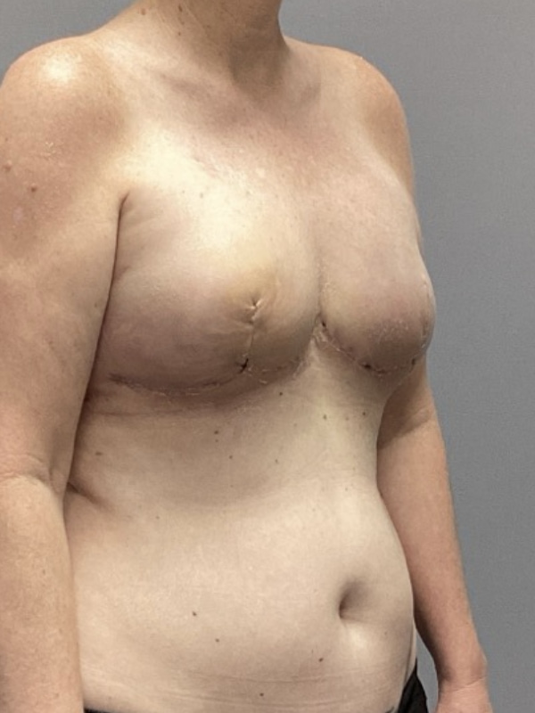 Breast Reconstruction Before & After Image