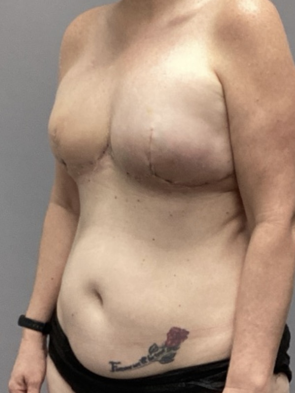 Breast Reconstruction Before & After Image