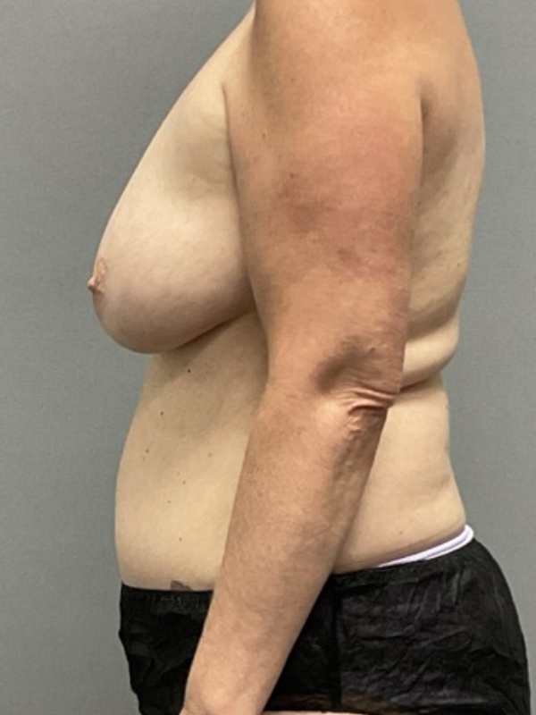 Breast Reconstruction Before & After Image