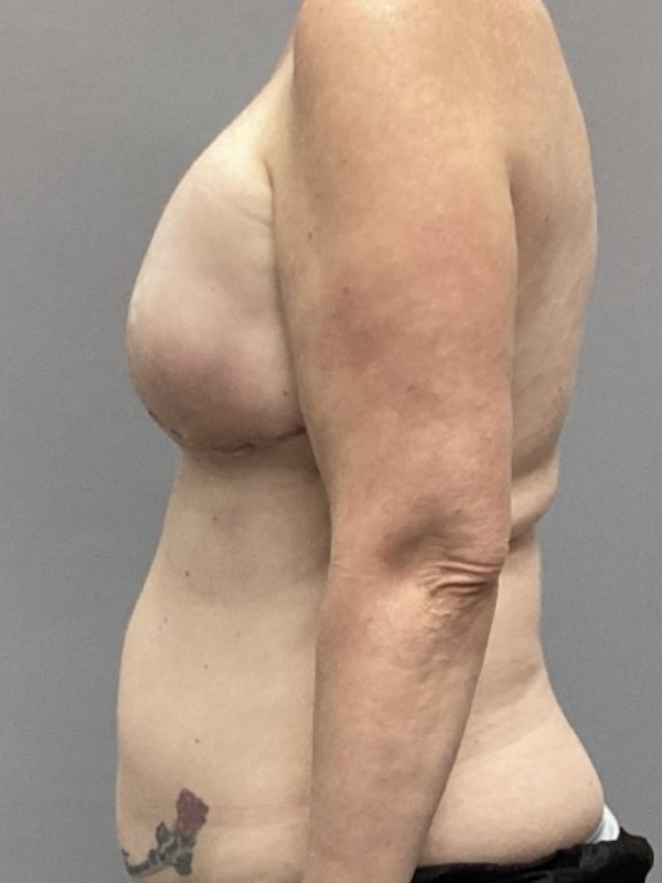 Breast Reconstruction Before & After Image